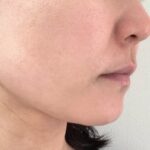 ディオーネは効果なし？顔脱毛3年半後のリアルな結果を公開