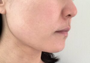 ディオーネの顔脱毛体験談：効果と11回の施術後の変化